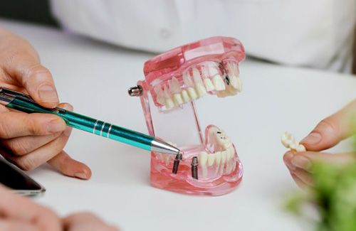 Dentist pointing to a model of an implant bridge