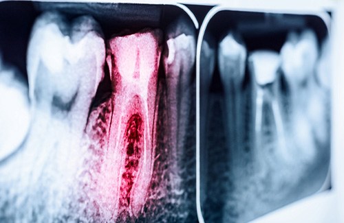 An X-ray of an infected tooth