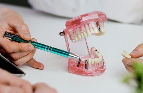 Dentist pointing to model of dental implant