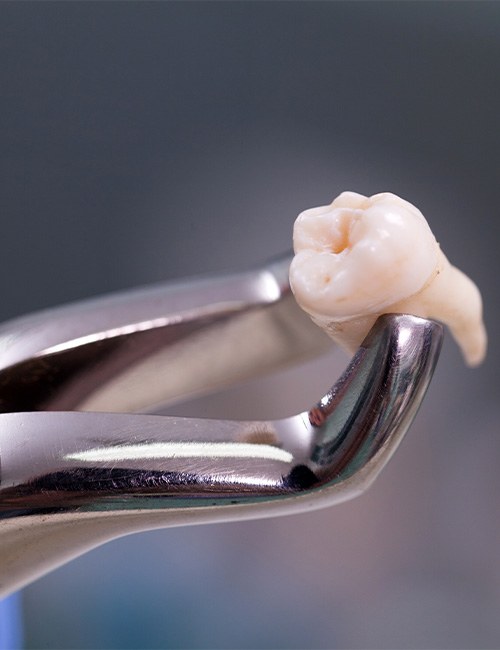 A close-up of a tooth being held with forceps