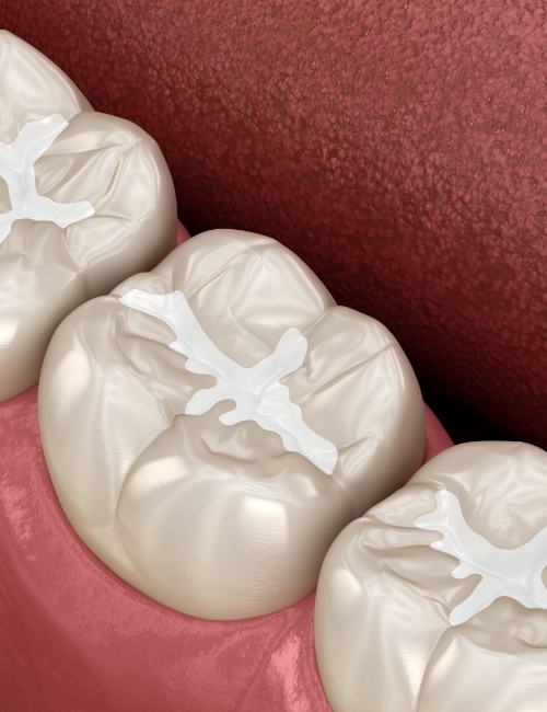 Animated smile with tooth colored fillings