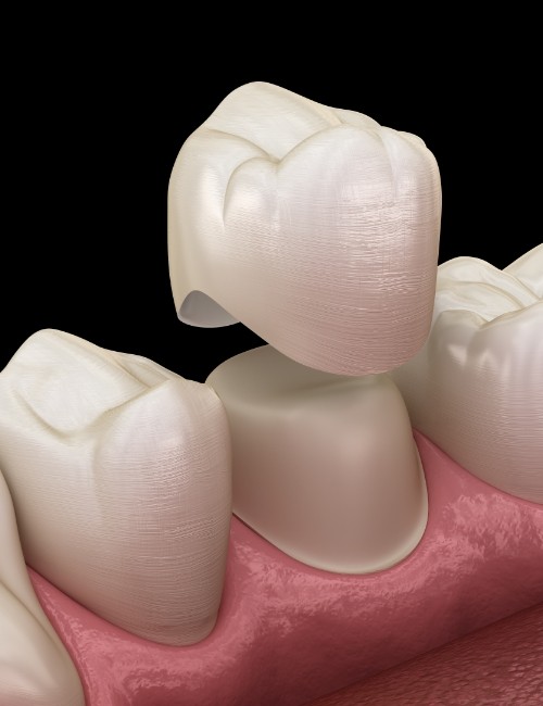 Animated smile during dental crown placement
