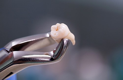 Closeup of extracted tooth held by forceps