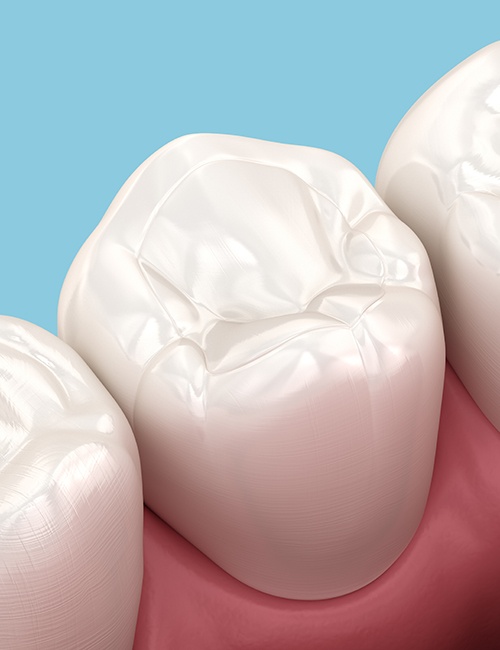 a 3D illustration of a tooth-colored filling