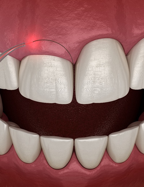 A CGI of a gum recontouring procedure