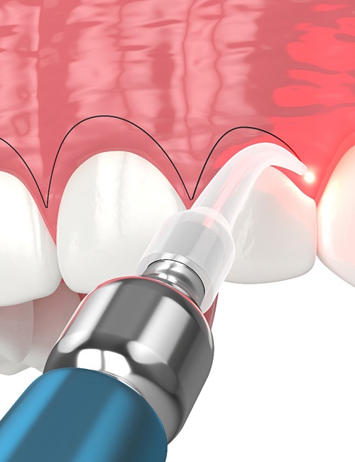 A CGI of a soft-tissue laser recontouring gums