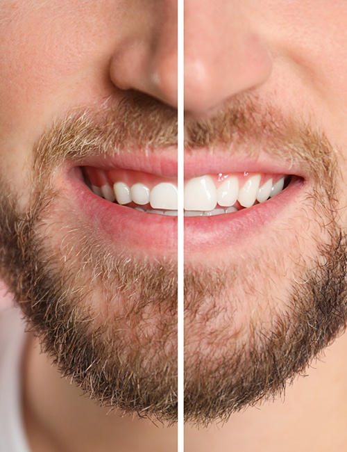 A man before and after gum recontouring