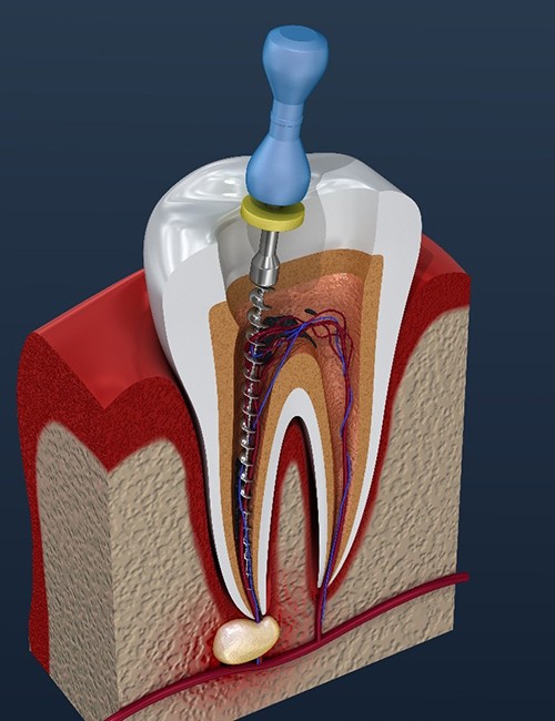 Illustration of instrument being used during root canal treatment