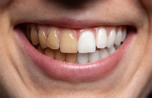 Up-close view of stained and brighter teeth
