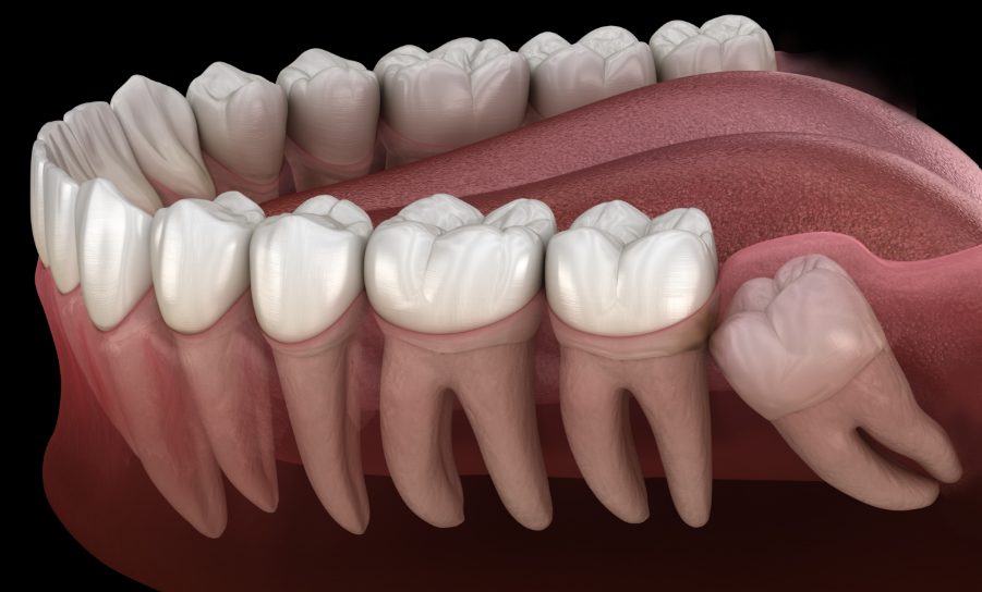 Cross section of wisdom teeth