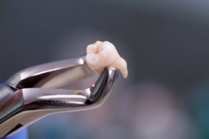 Extracted tooth. 